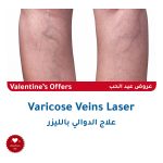 Varicous-Laser