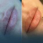 ⁦تجديد الشفاه بالليزر⁩ - الصورة ⁦2⁩