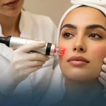 RF Ultra Microneedling