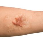 علاج ندبات الحروق مع SVF