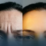⁦حقن النيوروتوكسين (منطقتان)⁩ - الصورة ⁦2⁩