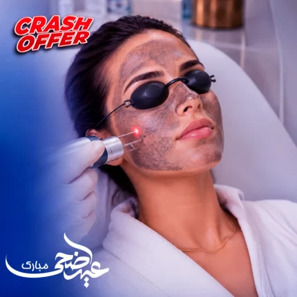 Carbon Laser treatment